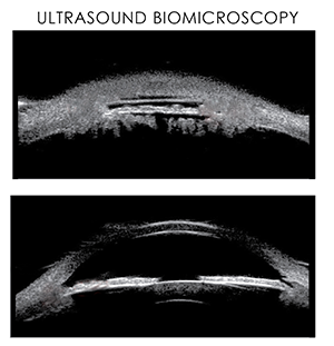 Ultrasound Biomicroscopy